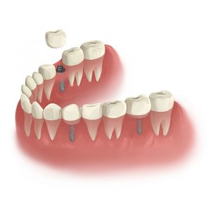 What Happens After Wisdom Tooth Extraction? 